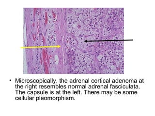 • Microscopically, the adrenal cortical adenoma at
the right resembles normal adrenal fasciculata.
The capsule is at the left. There may be some
cellular pleomorphism.
 