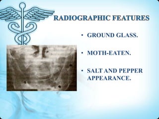 • GROUND GLASS.
• MOTH-EATEN.
• SALT AND PEPPER
APPEARANCE.

 