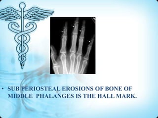 • SUB PERIOSTEAL EROSIONS OF BONE OF
MIDDLE PHALANGES IS THE HALL MARK.

 