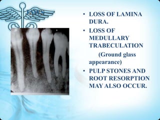• LOSS OF LAMINA
DURA.
• LOSS OF
MEDULLARY
TRABECULATION
(Ground glass
appearance)
• PULP STONES AND
ROOT RESORPTION
MAY ALSO OCCUR.

 
