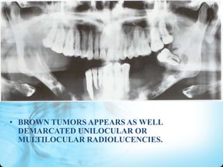 • BROWN TUMORS APPEARS AS WELL
DEMARCATED UNILOCULAR OR
MULTILOCULAR RADIOLUCENCIES.

 