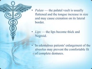 • Palate — the palatal vault is usually
flattened and the tongue increase in size
and may cause crenation on its lateral
border.
• Lips — the lips become thick and
Negroid.
• In edentulous patients' enlargement of the
alveolus may prevent the comfortable fit
of complete dentures.

 