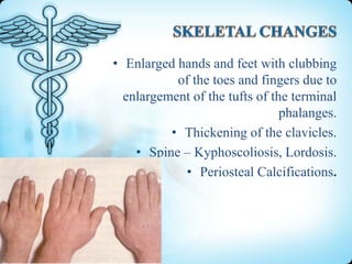 • Enlarged hands and feet with clubbing
of the toes and fingers due to
enlargement of the tufts of the terminal
phalanges.
• Thickening of the clavicles.
• Spine – Kyphoscoliosis, Lordosis.
• Periosteal Calcifications.

 