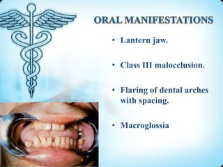 • Lantern jaw.
• Class III malocclusion.

• Flaring of dental arches
with spacing.
• Macroglossia

 