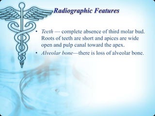 • Teeth — complete absence of third molar bud.
Roots of teeth are short and apices are wide
open and pulp canal toward the apex.
• Alveolar bone—there is loss of alveolar bone.

 
