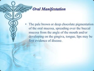 • The pale brown or deep chocolate pigmentation
of the oral mucosa, spreading over the buccal
mucosa from the angle of the mouth and/or
developing on the gingiva, tongue, lips may be
first evidence of disease.

 