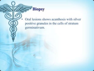 • Oral lesions shows acanthosis with silver
positive granules in the cells of stratum
germinativum.

 
