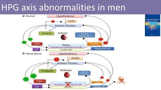 HPG axis abnormalities in men
 