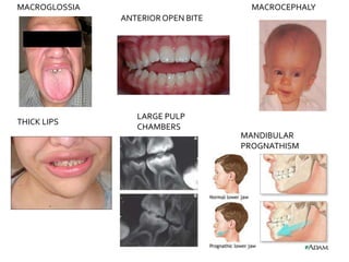 MACROGLOSSIA MACROCEPHALY
THICK LIPS
LARGE PULP
CHAMBERS
ANTERIOROPEN BITE
MANDIBULAR
PROGNATHISM
 