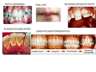 TEETH CROWDING
PLAQUEACCUMULATION
RETAINED DECIDOUSTEETH
THIN LIPS
GINGIVITISAND PERIODONTITIS
 