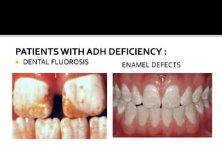 PATIENTSWITH ADH DEFICIENCY :
 DENTAL FLUOROSIS ENAMEL DEFECTS
 