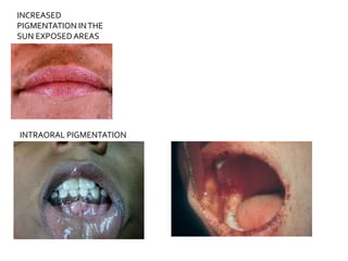 INCREASED
PIGMENTATION INTHE
SUN EXPOSEDAREAS
INTRAORAL PIGMENTATION
 