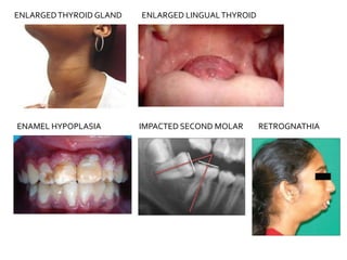 ENLARGEDTHYROID GLAND ENLARGED LINGUALTHYROID
ENAMEL HYPOPLASIA IMPACTED SECOND MOLAR RETROGNATHIA
 