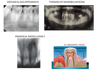 GROUND GLASS APPEARANCE THINNING OF MANDIBULAR BONE
PERIAPICAL RADIOLUCENCY
 