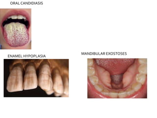 ORAL CANDIDIASIS
ENAMEL HYPOPLASIA
MANDIBULAR EXOSTOSES
 