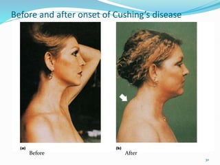 30
Before and after onset of Cushing’s disease
After
Before
 