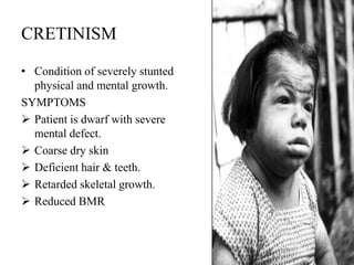 CRETINISM

• Condition of severely stunted
  physical and mental growth.
SYMPTOMS
 Patient is dwarf with severe
  mental defect.
 Coarse dry skin
 Deficient hair & teeth.
 Retarded skeletal growth.
 Reduced BMR
 