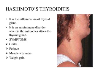 HASHIMOTO’S THYROIDITIS

• It is the inflammation of thyroid
  gland.
• It is an autoimmune disorder
  wherein the antibodies attack the
  thyroid gland.
• SYMPTOMS
 Goitre
 Fatigue
 Muscle weakness
 Weight gain
 
