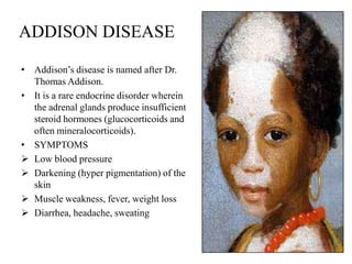 ADDISON DISEASE

• Addison’s disease is named after Dr.
  Thomas Addison.
• It is a rare endocrine disorder wherein
  the adrenal glands produce insufficient
  steroid hormones (glucocorticoids and
  often mineralocorticoids).
• SYMPTOMS
 Low blood pressure
 Darkening (hyper pigmentation) of the
  skin
 Muscle weakness, fever, weight loss
 Diarrhea, headache, sweating
 