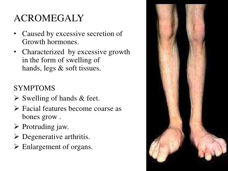 acromegaly symptoms