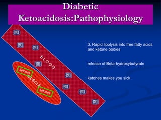 Diabetic
Ketoacidosis:Pathophysiology
3. Rapid lipolysis into free fatty acids
and ketone bodies
release of Beta-hydroxybutyrate
ketones makes you sick
 