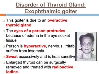 Disorder of Thyroid Gland:
Exophthalmic goiter
 This goiter is due to an overactive
thyroid gland
 The eyes of a person protrudes
because of edema in the eye socket
tissue
 Person is hyperactive, nervous, irritable,
suffers from insomnia.
 Sweat excessively and is heat sensitive.
 Enlarged thyroid can be surgically
removed and treated with radioactive
iodine.
 