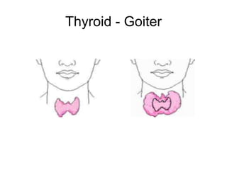 Thyroid - Goiter
 