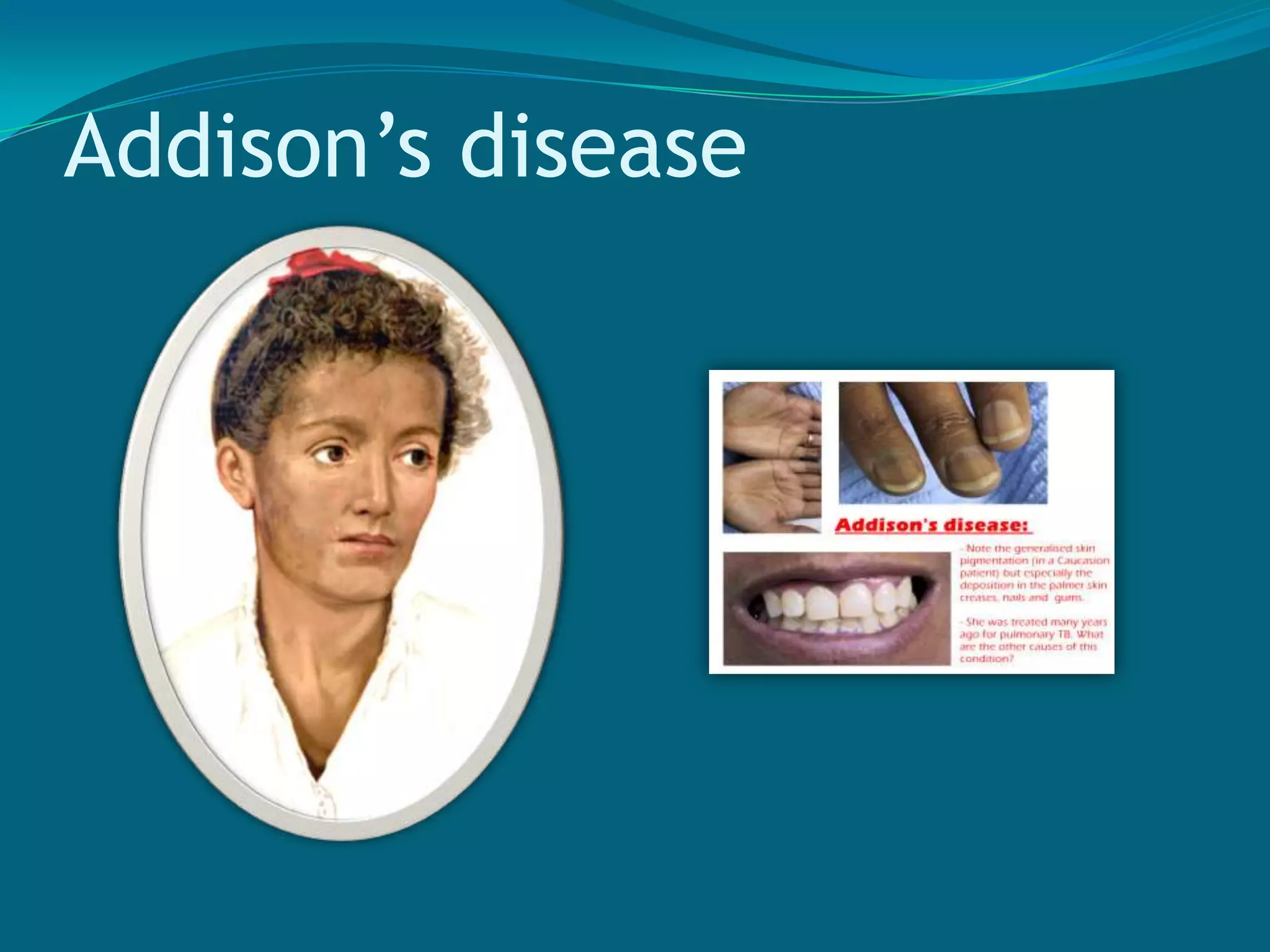  loss of beta cell responsiveness to glucose leading to   slow or  insulin release by the pancreas occurs over age 40 but can occur in children
