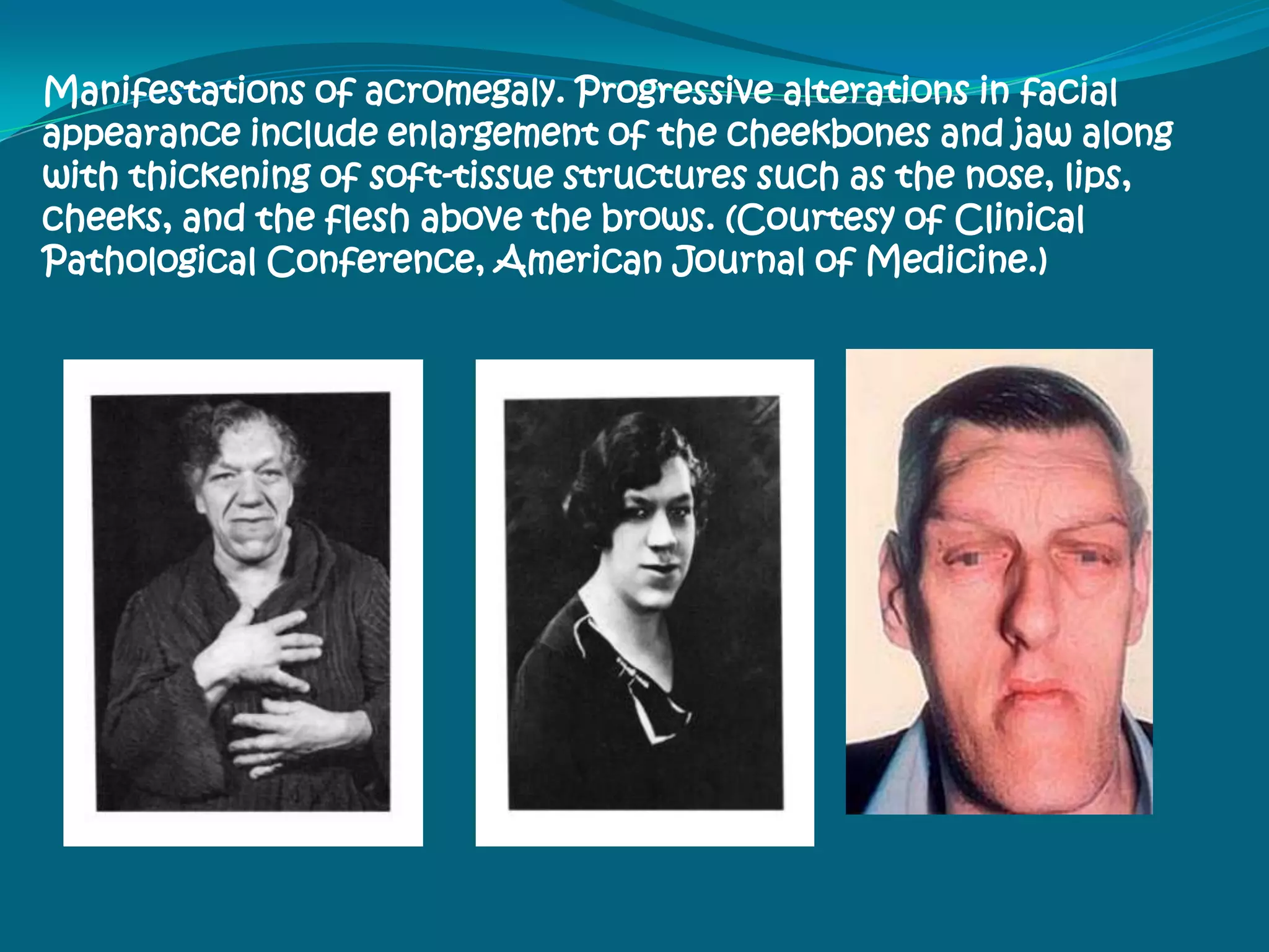 ANTERIOR PITUITARY  DISTURBANCESHYPOPITUITARISMHYPERPITUITARISM