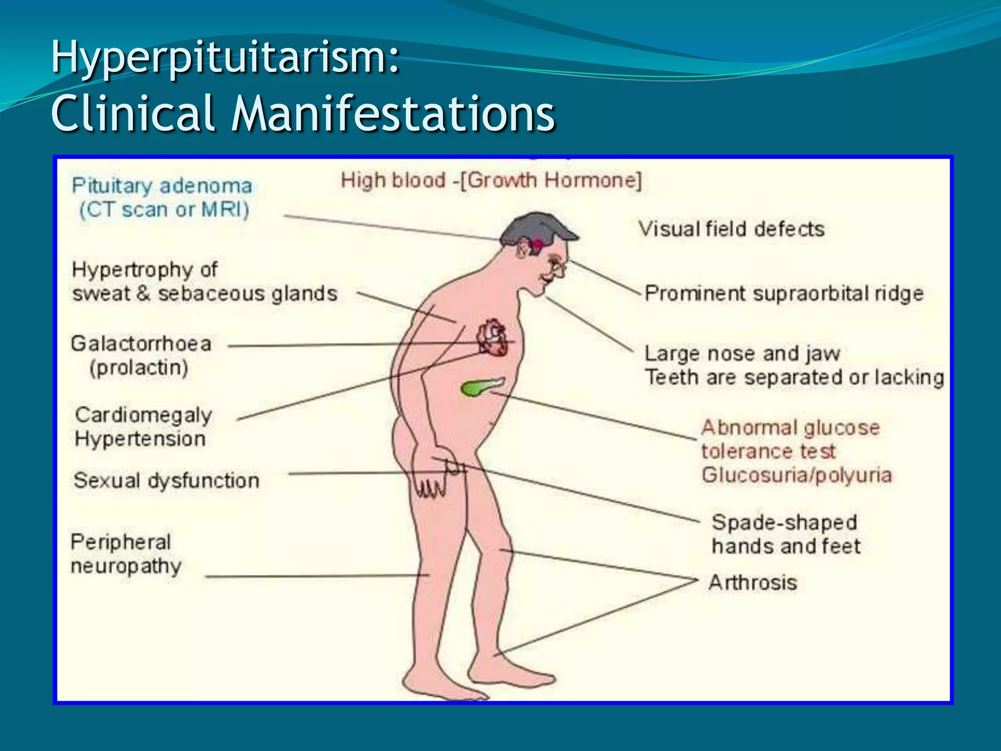 HyperpituitarismMay be due to overactivity of glandor the result of an adenomaCharacterized by:Excessive serum concentrationof pituitary hormones (GH, ACTH, PRL)Morphologic and functional changesin the anterior pituitary