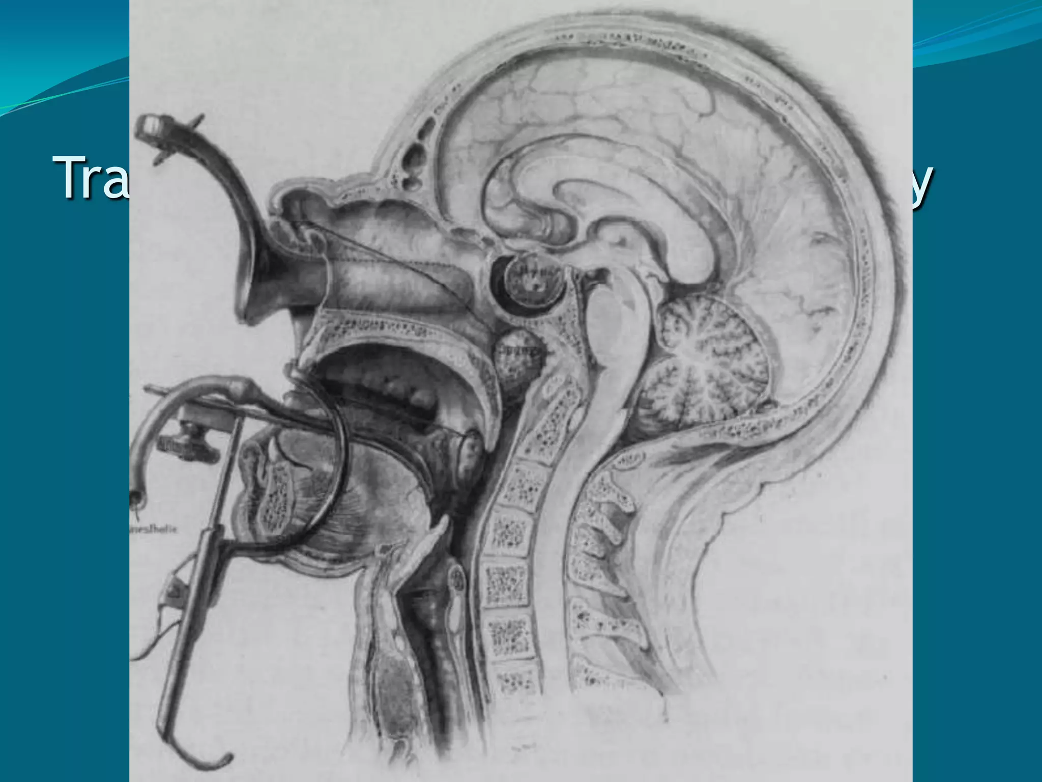 HypopituitarismDeficiency of one or moreanterior pituitary hormonesCausesInfections / Inflammatory disordersAutoimmune diseasesCongenital absenceTumorSurgery / Radiation therapy