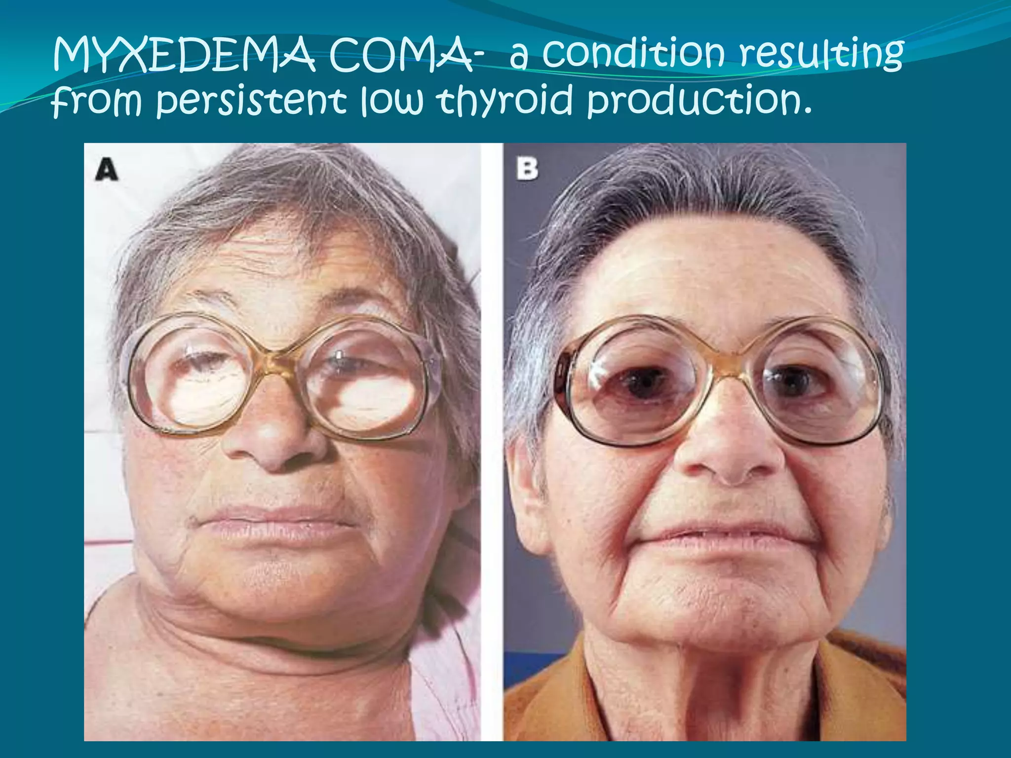 HypothyroidismA state of low serum TH levelsor cellular resistance to THIodine deficiencyOncologicAutoimmuneDrugsDevelopmentalIatrogenicDietaryNon-thyroidalEndocrine