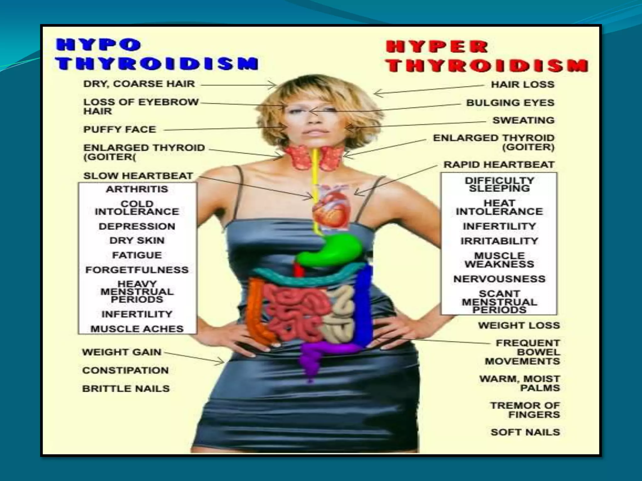 Thyroid Storm or Crisis a medical emergency pts. develop severe    manifestation of hyperthyroidism   temp., tachycardia, dysrhythmias worsening tremors, restlessness delirious or psychotic state or coma abdominal pain  BP and RRPrecipitated by a major stressor:  infection trauma or surgery (thyroidectomy) inadequate treatment