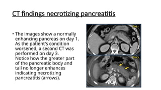 CT findings necrotizing pancreatitis
• The images show a normally
enhancing pancreas on day 1.
As the patient's condition
worsened, a second CT was
performed on day 3.
Notice how the greater part
of the pancreatic body and
tail no longer enhances
indicating necrotizing
pancreatitis (arrows).
 