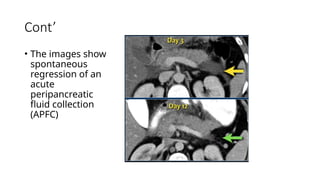 Cont’
• The images show
spontaneous
regression of an
acute
peripancreatic
fluid collection
(APFC)
 