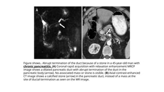 Figure shows.. Abrupt termination of the duct because of a stone in a 45-year-old man with
chronic pancreatitis. (A) Coronal rapid acquisition with relaxation enhancement MRCP
image shows a dilated pancreatic duct with abrupt termination of the duct in the
pancreatic body (arrow). No associated mass or stone is visible. (B) Axial contrast-enhanced
CT image shows a calcified stone (arrow) in the pancreatic duct, instead of a mass at the
site of ductal termination as seen on the MR image.
 