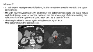 MR versus CT
• CT will depict most pancreatic lesions, but is sometimes unable to depict the cystic
component.
• MR with heavily weighted T2WI and MRCP will better demonstrate the cystic nature
and the internal structure of the cyst and has the advantage of demonstrating the
relationship of the cyst to the pancreatic duct as is seen in IPMN.
• The images show a serous cystic neoplasm (SCN) on a CT.
MRI better shows the central scar.
 