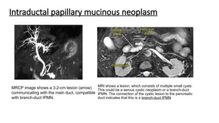 Intraductal papillary mucinous neoplasm
MRI shows a lesion, which consists of multiple small cysts.
This could be a serous cystic neoplasm or a branch-duct
IPMN. The connection of the cystic lesion to the pancreatic
duct indicates that this is a branch-duct IPMN
MRCP image shows a 3.2-cm lesion (arrow)
communicating with the main duct, compatible
with branch-duct IPMN.
 