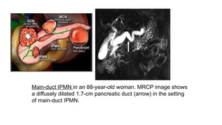 Main-duct IPMN in an 88-year-old woman. MRCP image shows
a diffusely dilated 1.7-cm pancreatic duct (arrow) in the setting
of main-duct IPMN.
 
