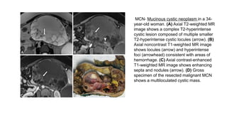 MCN- Mucinous cystic neoplasm in a 34-
year-old woman. (A) Axial T2-weighted MR
image shows a complex T2-hyperintense
cystic lesion composed of multiple smaller
T2-hyperintense cystic locules (arrow). (B)
Axial noncontrast T1-weighted MR image
shows locules (arrow) and hyperintense
foci (arrowhead) consistent with areas of
hemorrhage. (C) Axial contrast-enhanced
T1-weighted MR image shows enhancing
septa and nodules (arrow). (D) Gross
specimen of the resected malignant MCN
shows a multiloculated cystic mass.
 