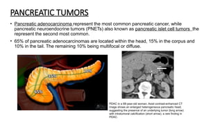 PANCREATIC TUMORS
• Pancreatic adenocarcinoma represent the most common pancreatic cancer, while
pancreatic neuroendocrine tumors (PNETs) also known as pancreatic islet cell tumors the
represent the second most common.
• 65% of pancreatic adenocarcinomas are located within the head, 15% in the corpus and
10% in the tail. The remaining 10% being multifocal or diffuse.
PDAC in a 68-year-old woman. Axial contrast-enhanced CT
image shows an enlarged heterogeneous pancreatic head,
suggesting the presence of an underlying tumor (long arrow)
with intratumoral calcification (short arrow), a rare finding in
PDAC.
 