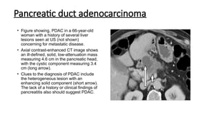 Pancreatic duct adenocarcinoma
• Figure showing, PDAC in a 66-year-old
woman with a history of several liver
lesions seen at US (not shown)
concerning for metastatic disease.
• Axial contrast-enhanced CT image shows
an ill-defined, solid, low-attenuation mass
measuring 4.6 cm in the pancreatic head,
with the cystic component measuring 3.4
cm (long arrow).
• Clues to the diagnosis of PDAC include
the heterogeneous lesion with an
enhancing solid component (short arrow).
The lack of a history or clinical findings of
pancreatitis also should suggest PDAC.
 