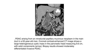 . PDAC arising from an intraductal papillary mucinous neoplasm in the main
duct in a 62-year-old man. Coronal contrast-enhanced CT image shows a
large heterogeneous cystic mass in the pancreatic head measuring 9.6 cm,
with solid components (arrow). Biopsy results showed moderately
differentiated invasive PDAC.
 
