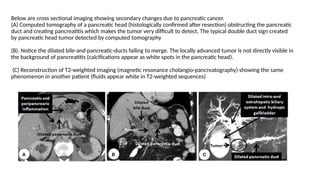 Below are cross sectional imaging showing secondary changes due to pancreatic cancer.
(A) Computed tomography of a pancreatic head (histologically confirmed after resection) obstructing the pancreatic
duct and creating pancreatitis which makes the tumor very difficult to detect. The typical double duct sign created
by pancreatic head tumor detected by computed tomography
(B). Notice the dilated bile-and pancreatic-ducts failing to merge. The locally advanced tumor is not directly visible in
the background of pancreatitis (calcifications appear as white spots in the pancreatic head).
(C) Reconstruction of T2-weighted imaging (magnetic resonance cholangio-pancreatography) showing the same
phenomenon in another patient (fluids appear white in T2-weighted sequences)
 