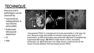 TECHNIQUE
Pancreas and it
pathologies can be
assessed by.
• Convectional
radiography(A. X-
ray)-chronic
pancreatitis
• Endoscopic
Ultrasound-
abdominal
• CT
• MRI
Unsuspected PDAC in a background of acute pancreatitis in a 63-year-old
man. Because acute pancreatitis of unknown cause was seen at a CT
examination, an MRI examination was performed. (A) Axial T2-weighted fat-
suppressed MR image. (B) MRCP image shows a mass, prompting
endoscopic US. (C) Endoscopic US image shows a mass (arrow) as the
cause of ductal dilatation that was biopsy-proven PDAC
 