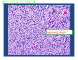 This is the microscopic appearance of a pituitary
adenoma.
Note that the sheets of cells all look the
same (in her words: "monotonous
population of polygonal cells).
 