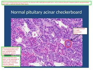 Normal pituitary acinar checkerboard
This is normal pituitary tissue noted for its diverse cells, well-demarcated acini, and a robust reticulin network (which would be best
seen with a special reticulin fiber stain).
Note the diversity of cells
in normal pituitary. You
have acidophils and
basophils of various
staining intensity.
note the example
of a well-
demarcated
acinus
Look at how the acini
seem to be separated. A
reticulin stain would
show a very nice intact
reticulin network
surrounding each acinus.
 