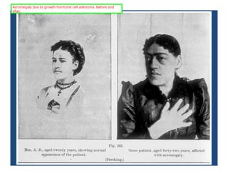 Acromegaly due to growth hormone cell adenoma. Before and
after.
 