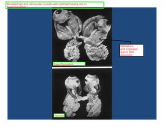 edematous
and engorged
due to GAG
deposition
Dissected eye and retro-ocular muscles with ophthalmopathy due to
hyperthyroidism.
Normal
hyperthyroidism
 