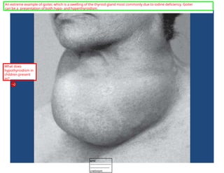An extreme example of goiter, which is a swelling of the thyroid gland most commonly due to iodine deficiency. Goiter
can be a presentation of both hypo- and hyperthyroidism.
What does
hypothyroidism in
children present
as?
tcl12
-----------------------
---------------------
cretinism
 